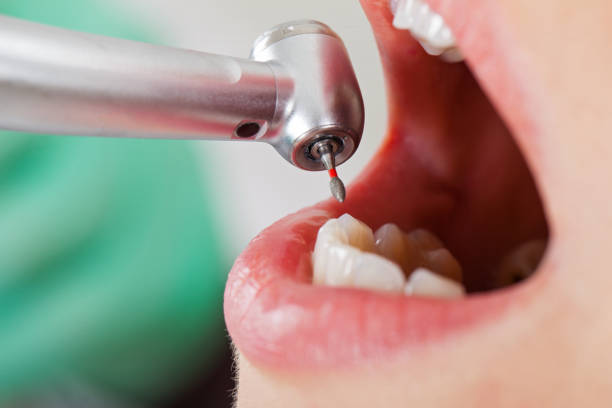 Best Emergency Tooth Extraction in Haymarket, VA